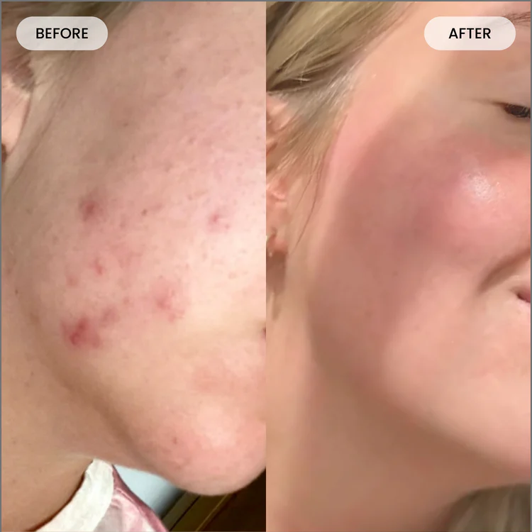 Acne & Blemishes