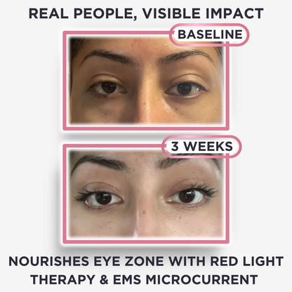 EyeLumen™ – Under-Eye Red Light Therapy Device