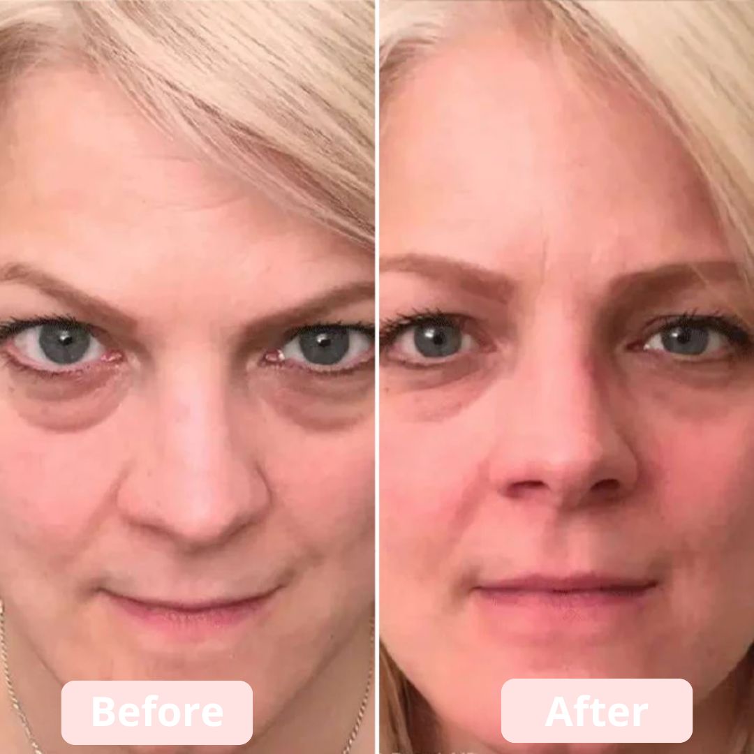 EyeLumen™ – Under-Eye Red Light Therapy Device
