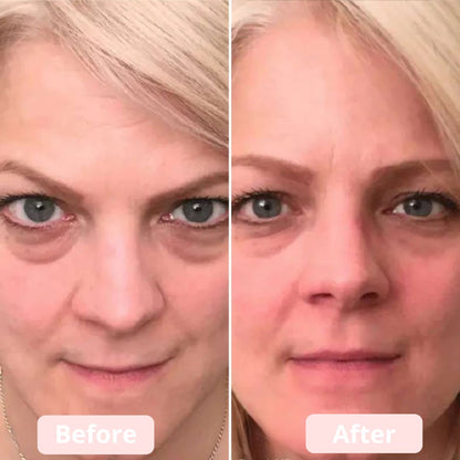 EyeLumen™ – Under-Eye Red Light Therapy Device