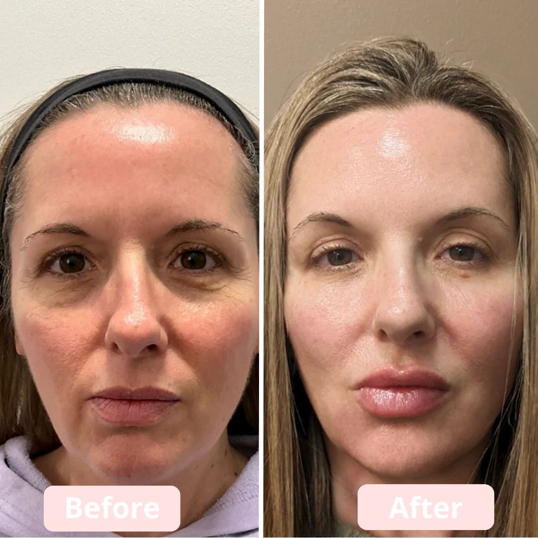 EyeLumen™ – Under-Eye Red Light Therapy Device