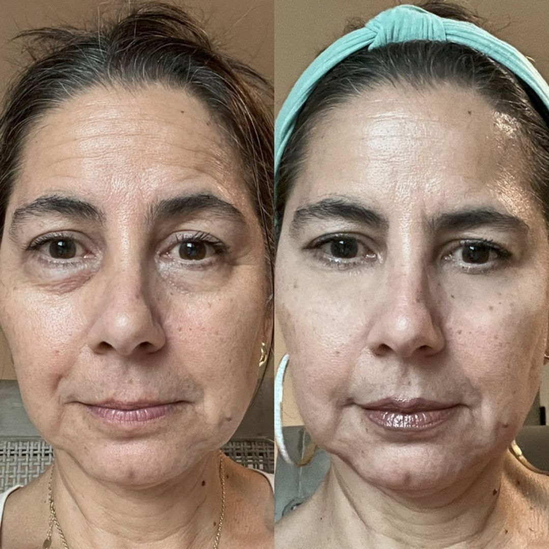 Fine Lines and Wrinkles