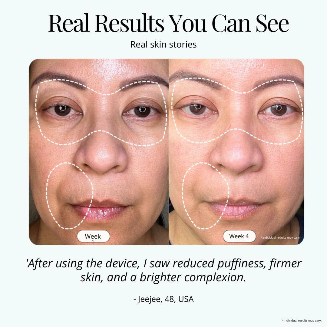 NovaLume RegenMask Pro beauty device showcasing visible skin renewal results on a user's face.